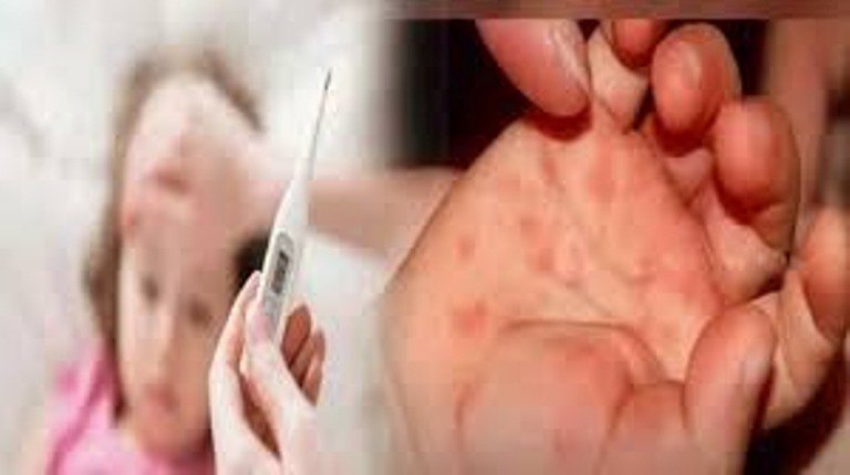 उत्तराखंड शासन ने की गाइडलाइंस जारी, बच्चों में फैलने वाली टोमैटो फ्लू से बचाव के लिए, जानिए क्या हैं उपचार।