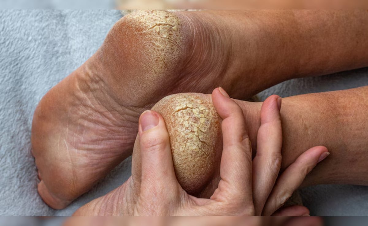आइये जानते है किस विटामिन की कमी से एड़ी में दरार पड़ जाती है, बिवाई फटने का क्या कारण है, जान गए तो खुद कर लेंगे इलाज।